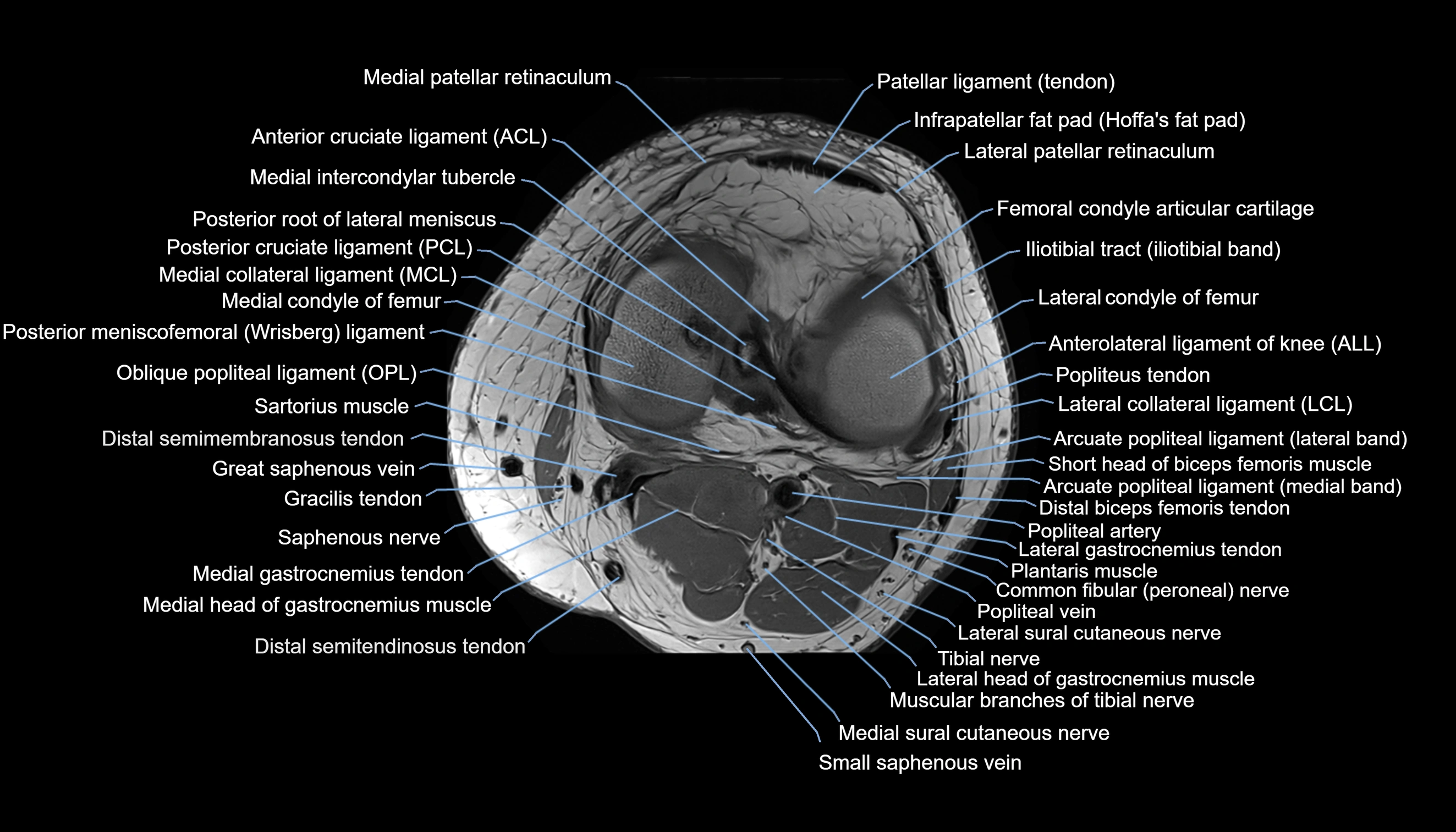 MRI knee  axial cross sectional anatomy 3T radiology  image-img-00001-00028.webp